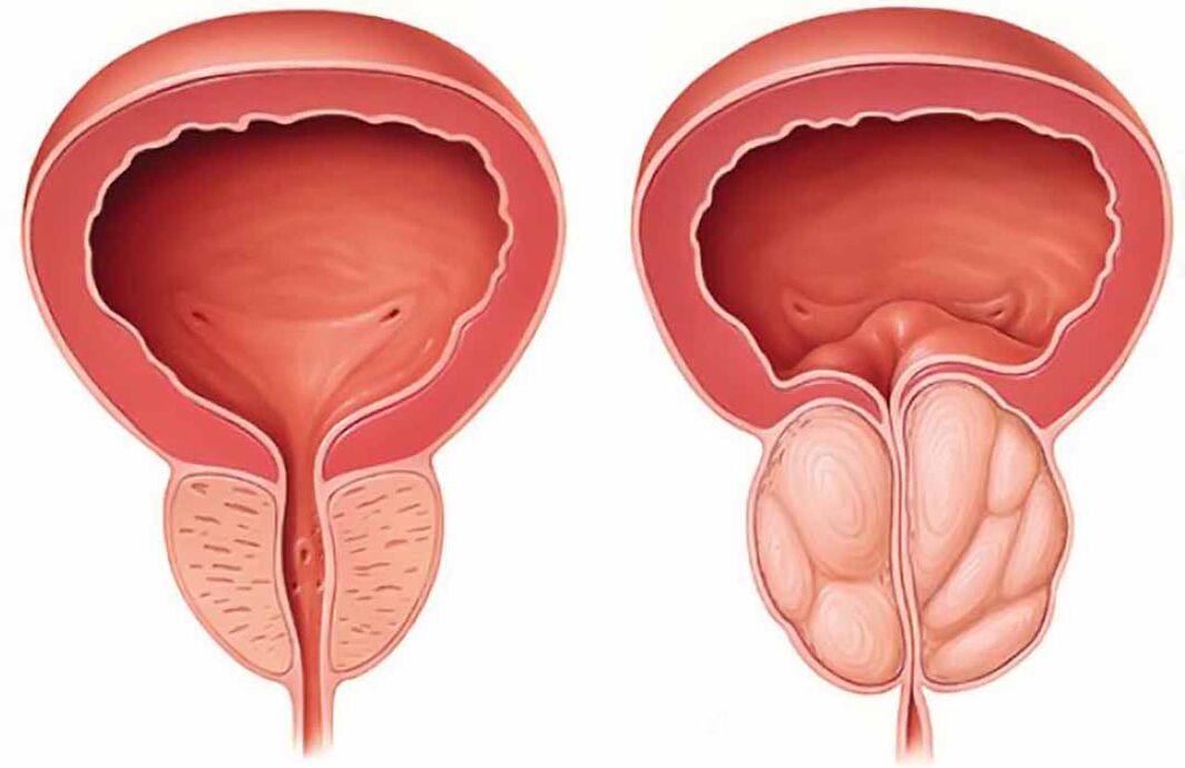 Próstata normal e inflamación da próstata (prostatite crónica)