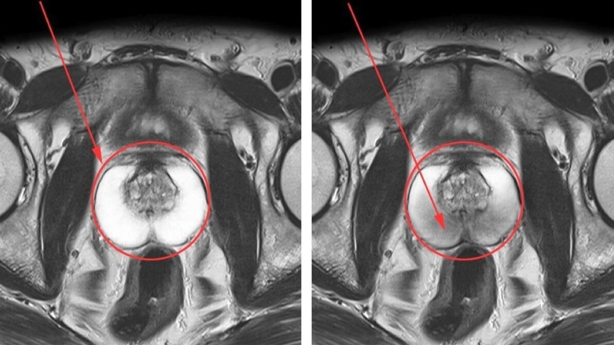 Ultrasóns para prostatite crónica próstata sa (esquerda) e próstata inflamada (dereita)