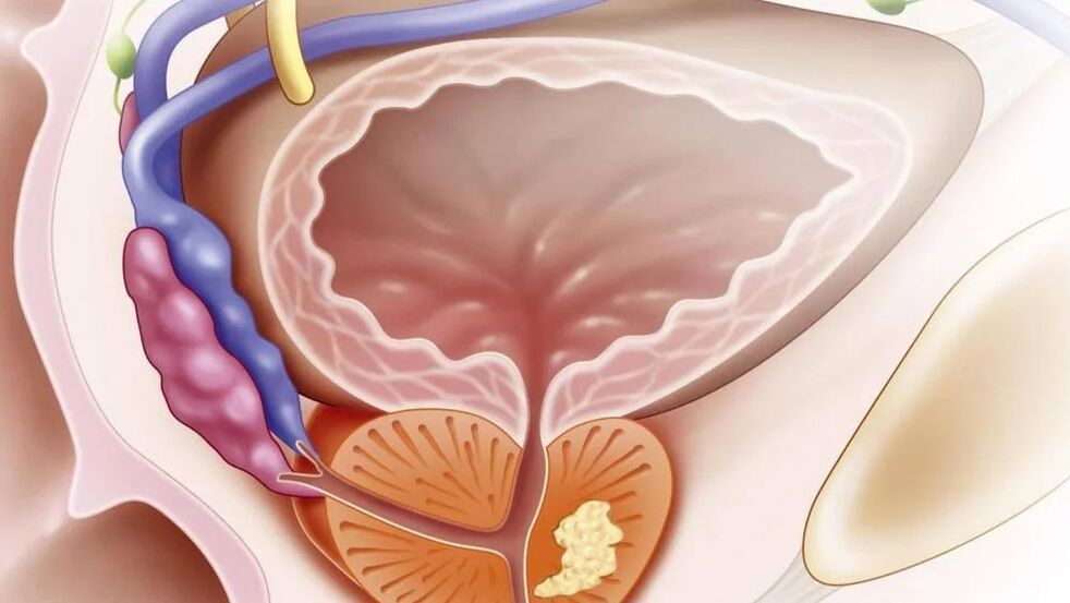 Nada de prostatite crónica