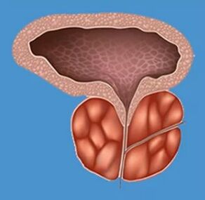 Signos característicos de prostatite