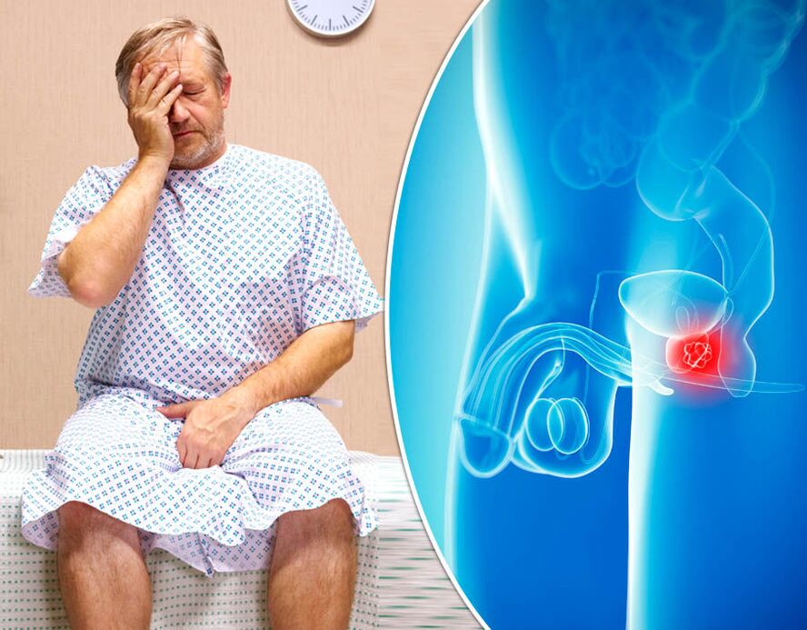 Un home con prostatite é diagnosticado coa enfermidade