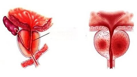 Como é a prostatite crónica